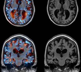 tomografia del cerebro. alzheimer