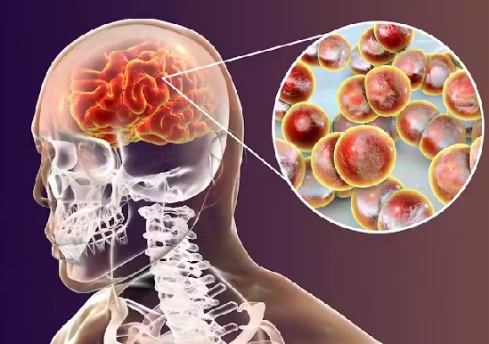 la meningitis y sus causas