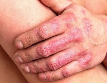 psoriasis