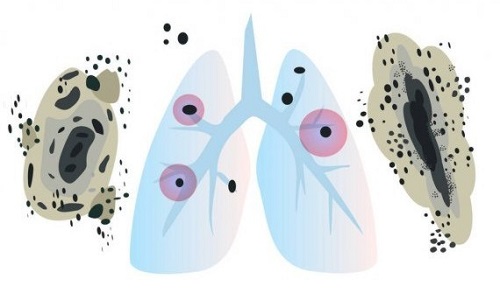 mucormicosis