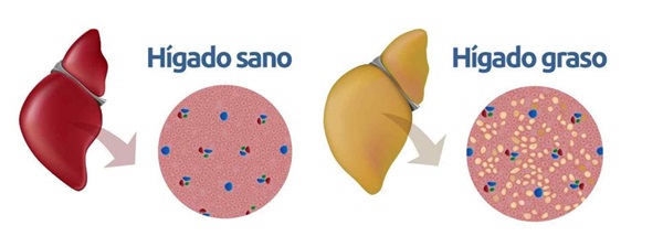 diferencias entre un hgado normal y un hgado graso