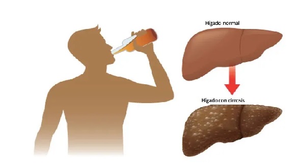 esteatosis heptica por alcohol